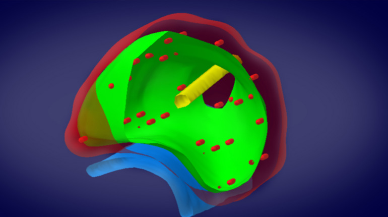 3D-Modell- Brachytherapie Urologie Emmendingen
